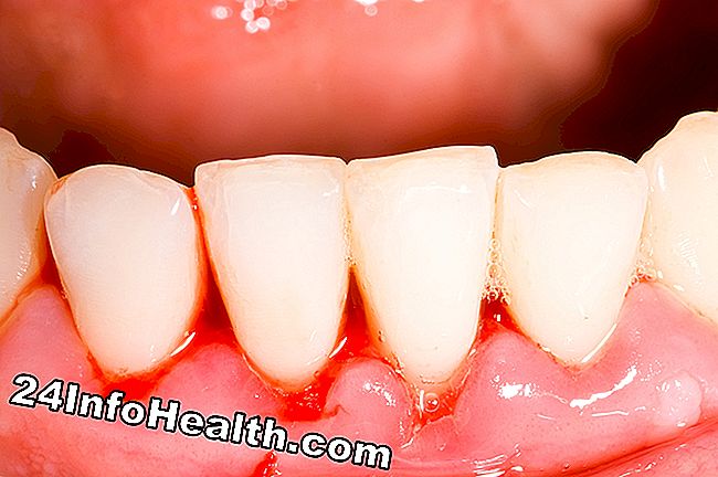 Es zeigt eine Person mit Gingivitis, die Zahnfleischschmerzen hat.
