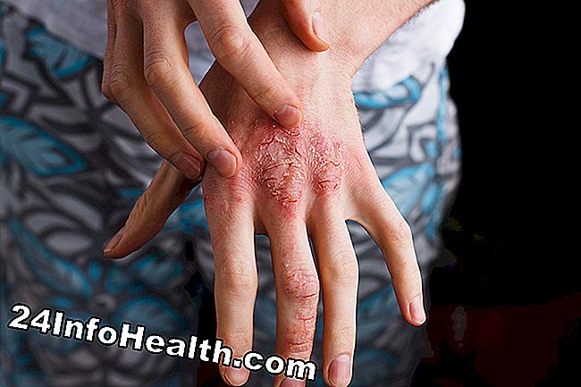 Het is een afbeelding van een persoon met eczeem (atopische dermatitis), die een bilaterale bovenste jeuk ervaart.