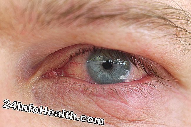 Det visar en person med kontaktlinsrelaterad ögoninfektion, som upplever en klar eller vit ögonutmatning.