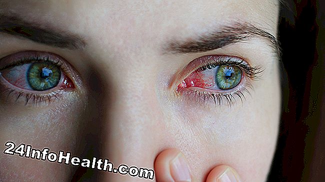 Det skildrar en person med vernal konjunktivit, som upplever en klar eller vit ögonutsläpp.