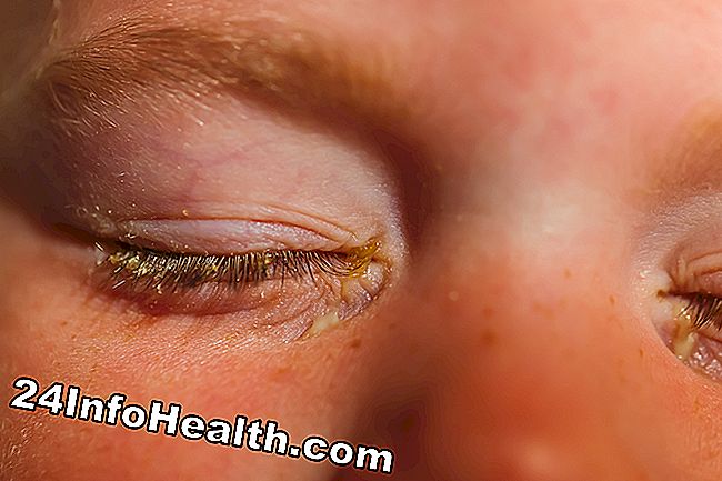 Det visar en person med bakteriell konjunktivit, som upplever en klar eller vit ögonutmatning.