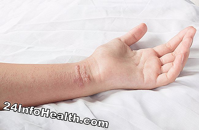 Sta raffigurando una persona con dermatite irritante da contatto, che sta vivendo un arrossamento della mano.