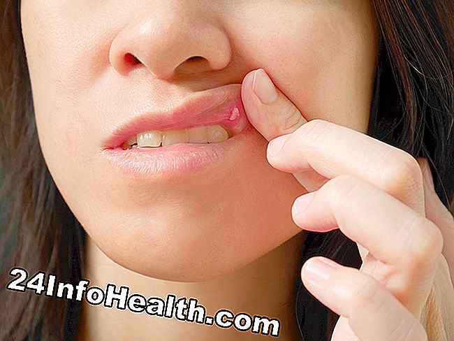 Nó được mô tả một người bị đau răng miệng, người đang trải qua một miệng đau giống như herpes miệng.