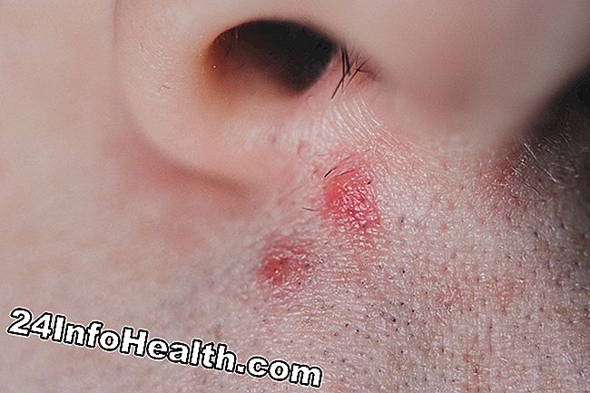 Pink eller Red Nose Bump Symptom, orsaker och vanliga frågor