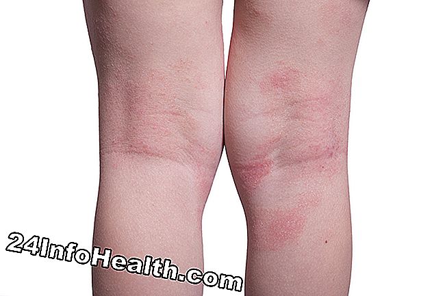Det skildrer en person med ikke-specifik dermatitis (hudbetændelse), der oplever udslæt på et underben.