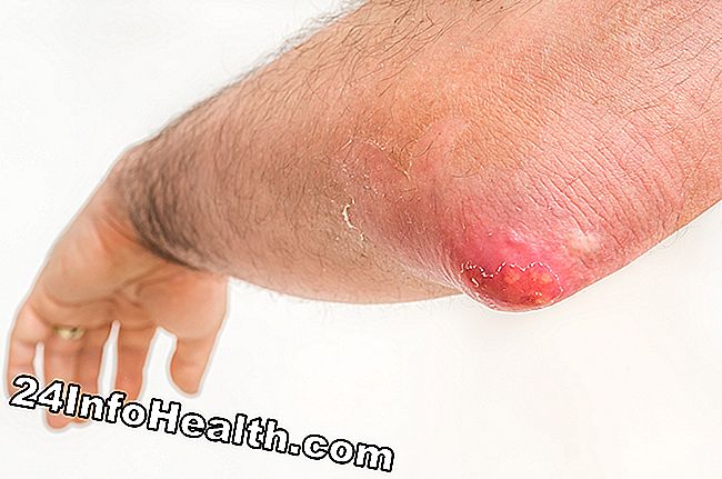 Si tratta di una persona con un punto di ebollizione (foruncolo), che sta vivendo un dosso rosso della pelle più grande di 1/2 cm di diametro.