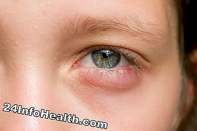 โรคและเงื่อนไข: อาการบวมบริเวณดวงตาสาเหตุและคำถามทั่วไป