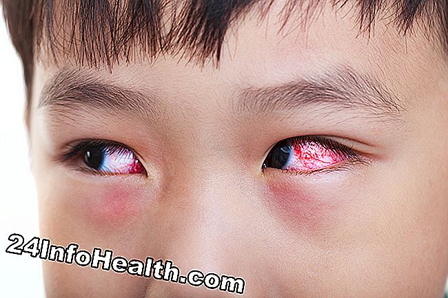Εμφανίζει ένα άτομο με χρόνια αλλεργική επιπεφυκίτιδα, το οποίο βιώνει ένα σκίσιμο στα δύο μάτια.