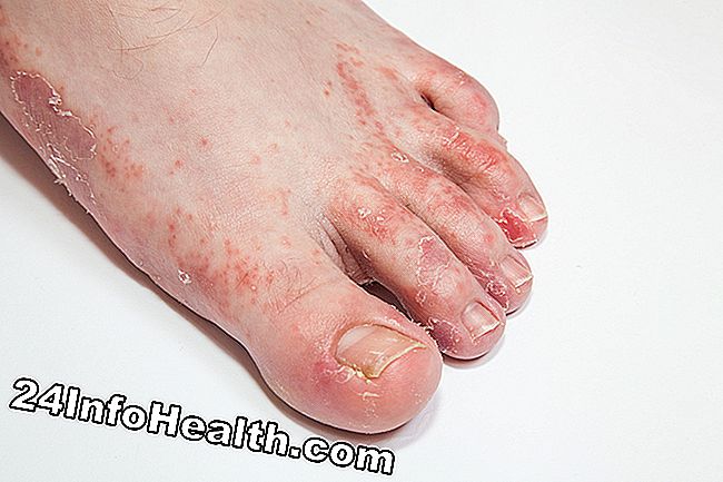 Εμφανίζει ένα άτομο με λοίμωξη του δέρματος από το πόδι, το οποίο αντιμετωπίζει πόνο στο toenail.