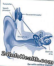 Conceptos básicos de audífonos: audífono