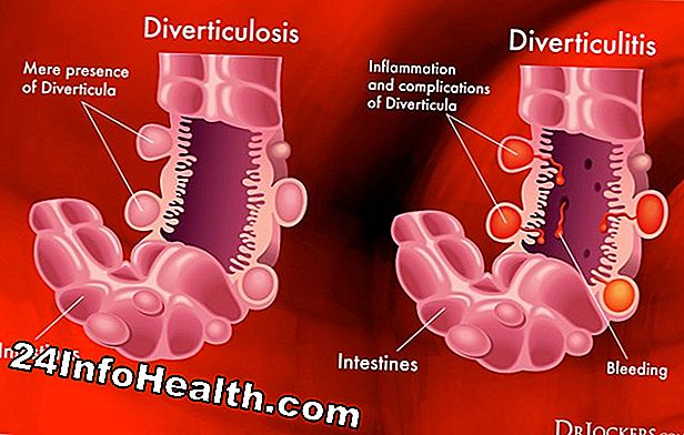 Wellness: 6 Home Remedies for Diverticular Disease