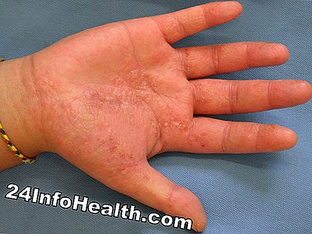 Hautpflege: 5 Hauterkrankungen, die Sie möglicherweise für Nesselsucht Fehler machen