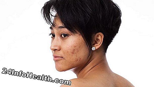 Hautpflege: Wie man Akne-Narben loswird