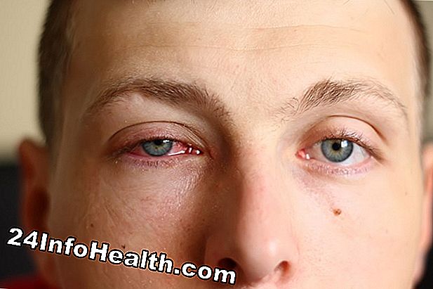 Doenças e condições: Previna os sintomas de alergia durante a viagem