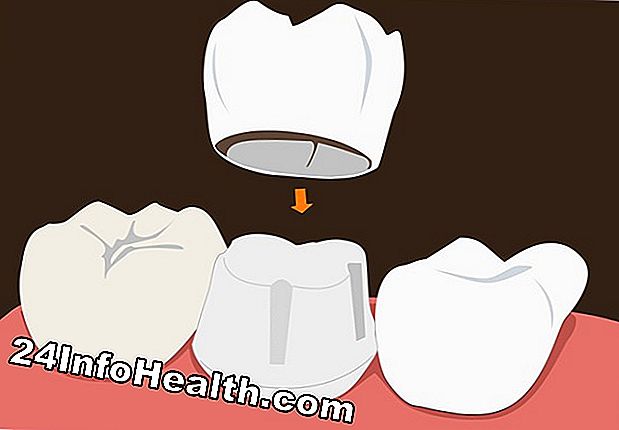 Wellness: Dental Crowns