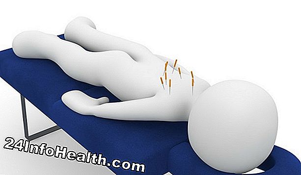 Enfermedades y condiciones: Acupuntura para el dolor de espalda