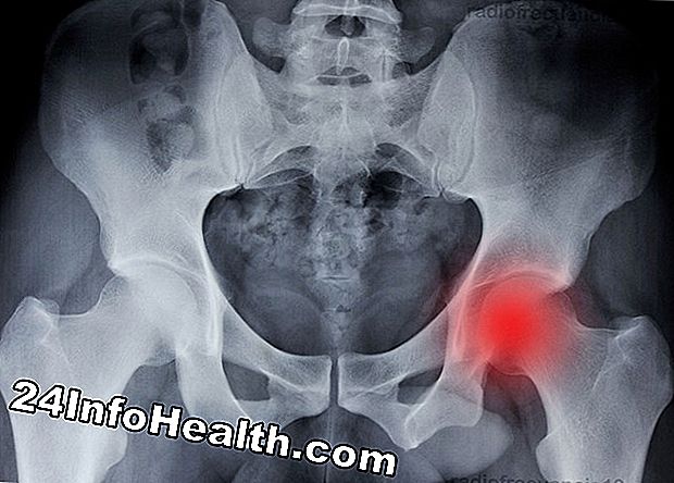 Radiofrecuencia para el dolor de espalda