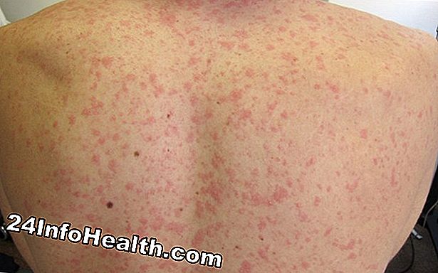 ¿A qué edad puede hacer una prueba de alergia en la piel?