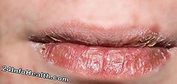 6 Remedios caseros para los labios agrietados