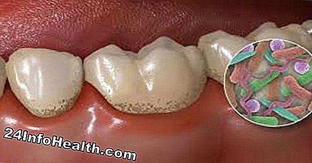 Bienestar: ¿Qué es la placa dental?