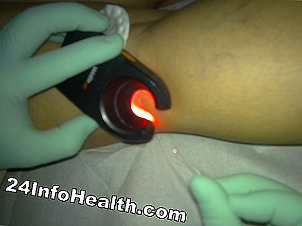 I laser sono un modo sicuro per trattare le vene varicose?