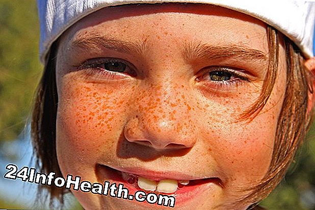 Cura della pelle: Perché le lentiggini escono al sole?