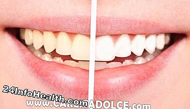 Benessere: 8 Home rimedi per i denti più bianchi