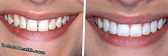 Benessere: Impiallacciature di denti