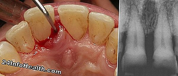 Benessere: Trattamento dell'ascesso del dente
