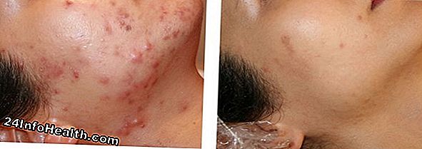 Huidsverzorging: Zijn chemische peelings veilig voor alle huidtypes?