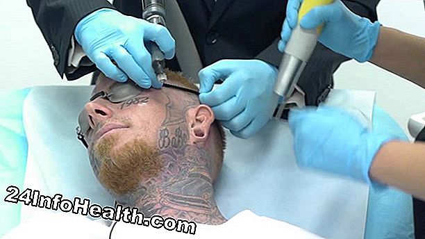 Huidsverzorging: Hoe tatoeage verwijderen werkt