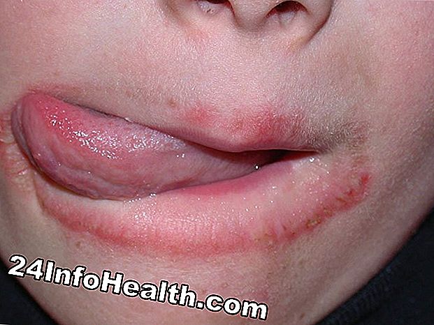 Wat veroorzaakt de rode ring rond mijn lippen?