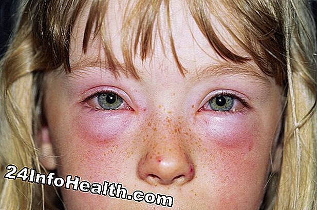 Sykdommer og forhold: Hva forårsaker allergier?
