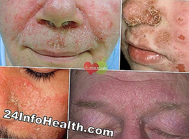 Cuidados com a pele: Caspa Causas e Tratamentos