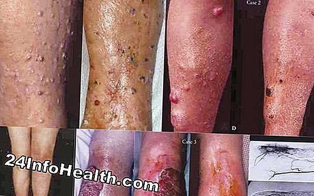 Cuidados com a pele: Como detectar uma toupeira cancerosa