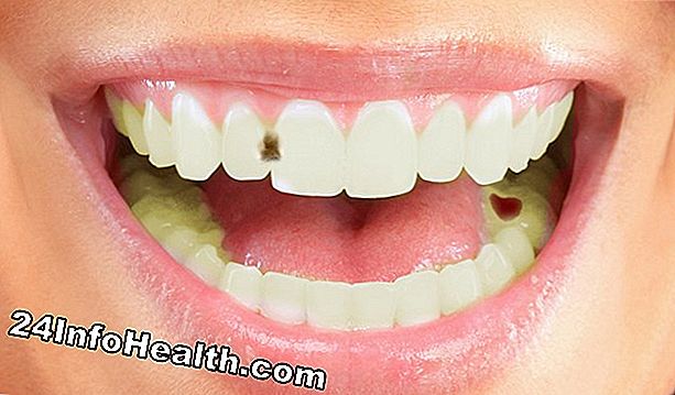Bem estar: Como as cavidades se formam nos dentes?