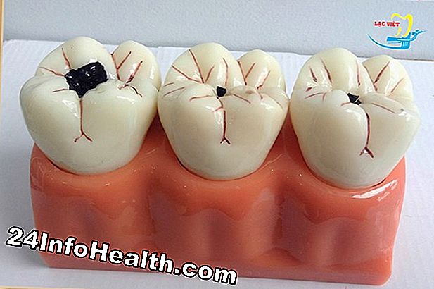Làm răng sâu răng cần phải được lấp đầy?