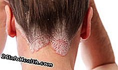 Cuidados com a pele: 5 Tratamentos para a psoríase do couro cabeludo