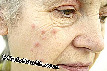 Hautpflege: Hives Überblick