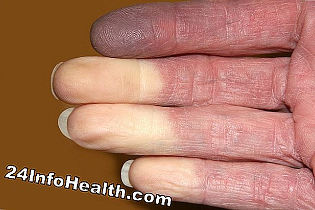 Sjukdomar och villkor: Flat, Blue / Purple Rash Symptom, orsaker och vanliga frågor