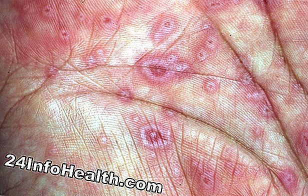 Hånd hud ændrer symptomer, årsager og almindelige spørgsmål