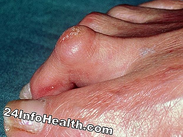 Sygdomme og tilstande: Hard Foot Symptomer, Årsager og Almindelige Spørgsmål