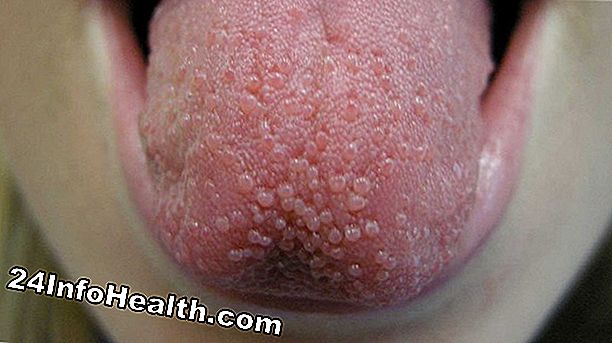 Sygdomme og tilstande: Oral Ulcer Symptomer, Årsager & Behandlingsmuligheder