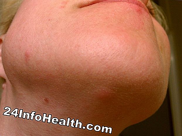 Sygdomme og tilstande: Pink eller Red Facial Bump Symptomer, Årsager og Almindelige Spørgsmål