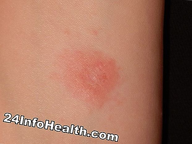Pink eller Red Arm Bump Symptom, orsaker och vanliga frågor