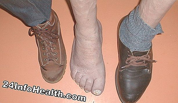 Unilateral Upper Leg Swelling Symptom, Orsaker och Frågor