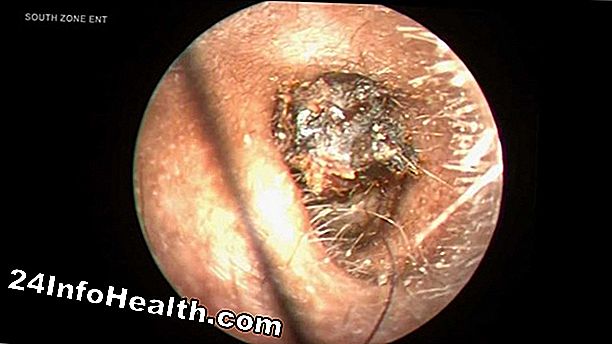 Sygdomme og tilstande: Waxy Ear Discharge Symptomer, Årsager og Almindelige Spørgsmål