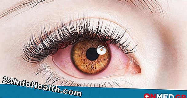 Ασθένειες & συνθήκες: Το κάψιμο των ματιών Συμπτώματα, αιτίες και συνήθεις ερωτήσεις