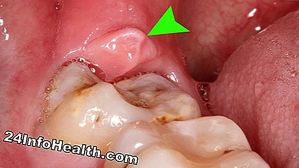 Molar Tooth Pain Συμπτώματα, αιτίες και επιλογές θεραπείας