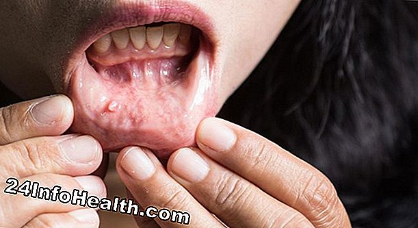 Ασθένειες & συνθήκες: Πόνος στη στέγη του στόματος Σύμπτωμα, αιτίες και ερωτήσεις